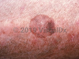 Clinical image of Large cell acanthoma - imageId=1033472. Click to open in gallery.  caption: 'A close-up of a variegated pink and brown stuck-on, wrinkled plaque.'