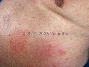 Clinical image of Systemic contact dermatitis - imageId=1052216. Click to open in gallery.  caption: 'Nitroglycerin reaction.'