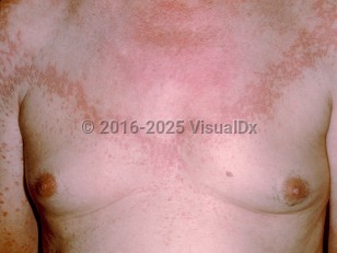 Clinical image of Generalized granuloma annulare - imageId=1073969. Click to open in gallery.  caption: 'Widespread smooth pink and brownish papules and plaques on the trunk and arm.'