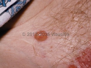 Bullous pemphigoid