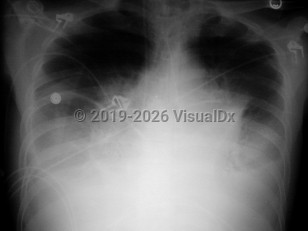 Inhalational anthrax