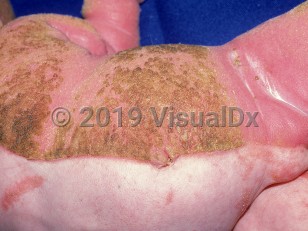Clinical image of CHILD syndrome - imageId=1403292. Click to open in gallery.  caption: 'Diffuse hyperkeratotic, pink plaques involving the left arm and leg and the left side of the trunk with a sharp midline cutoff. Note similar scant plaques with a blaschkoid configuration on the right side.'