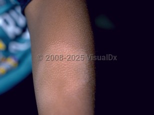 Clinical image of Pityriasis alba - imageId=143728. Click to open in gallery.  caption: 'A thin hypopigmented plaque with follicular prominence on the arm.'