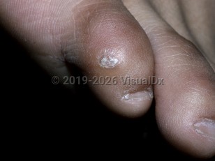 Clinical image of Clavus - imageId=150025. Click to open in gallery.  caption: 'A corn displaying a circumscribed plaque of thickened epidermis with a central scaly papule.'