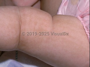 Clinical image of Linear and whorled nevoid hypermelanosis - imageId=1530346. Click to open in gallery.  caption: 'Linear and patterned brown patches in a blaschkoid distribution on the leg.'
