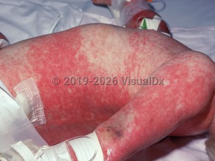 Acquired pancytopenia