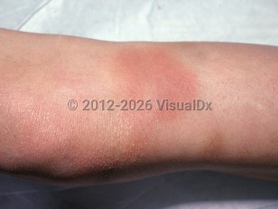 Von Willebrand disease