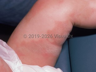 Clinical image of Erythrokeratodermia variabilis - imageId=1607091. Click to open in gallery.  caption: 'Patterned, scaly, yellowish, and erythematous plaques with surrounding erythematous macules and patches on the leg.'
