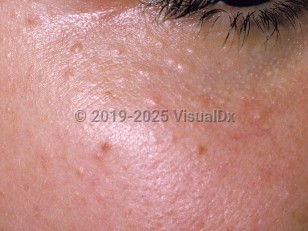 Clinical image of Syringoma - imageId=160788. Click to open in gallery.  caption: 'Many translucent and light brown papules on the cheek and inferior eyelid.'