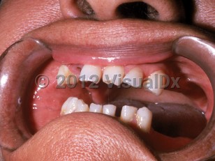 Clinical image of Early congenital syphilis - imageId=1708799. Click to open in gallery.  caption: 'Notched, widely-spaced teeth (Hutchinson teeth).'
