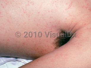 Clinical image of Fat emboli - imageId=1731889. Click to open in gallery.  caption: 'Myriads of pink and purpuric macules and papules on the trunk and arm, after a motor vehicle accident.'