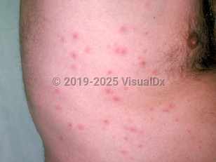 Clinical image of Pseudomonas folliculitis - imageId=175997. Click to open in gallery.  caption: 'Numerous erythematous and edematous perifollicular papules on the flank.'