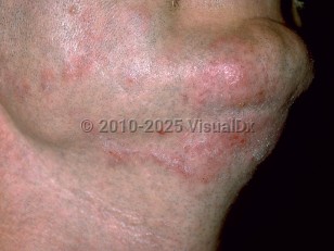 Clinical image of Tinea barbae - imageId=177152. Click to open in gallery.  caption: 'A close-up of scaly and crusted pink plaques in the beard area.'