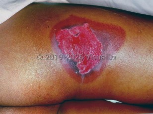 Acute radiation syndrome