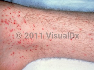 Clinical image of Atypical measles syndrome - imageId=1897265. Click to open in gallery.  caption: 'Numerous purpuric macules and papules on the leg.'