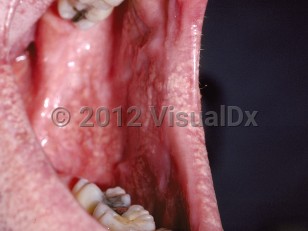 Clinical image of Fordyce spots - imageId=190784. Click to open in gallery.  caption: 'Pinpoint, discrete and confluent, yellow papules on the lower lip and at the oral commissure.'