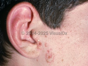 Clinical image of Gladiatorum herpes simplex virus - imageId=1919336. Click to open in gallery.  caption: 'A cluster of vesicles on the lateral cheek.'
