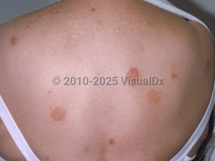 Clinical image of Nummular dermatitis - imageId=216877. Click to open in gallery.  caption: 'Discrete, round, light red and brown plaques on the back.'
