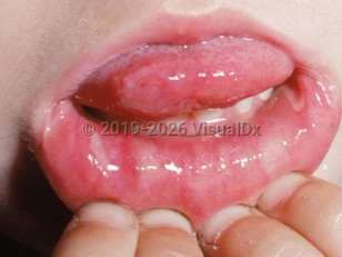 Clinical image of Aphthous stomatitis - imageId=2173448. Click to open in gallery.  caption: 'Two large, deep ulcers with overlying yellowish slough on the lower labial mucosa.'