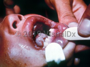 Clinical image of Endemic syphilis - imageId=2200140. Click to open in gallery.  caption: 'Slough-covered erosions and ulcers in the oral cavity and on the lips.'