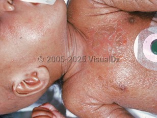 Clinical image of Marasmus - imageId=2356771. Click to open in gallery.  caption: 'Diffuse scaling of the trunk and arm in a very thin infant.'