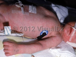 Clinical image of Argininosuccinic aciduria - imageId=2376924. Click to open in gallery.  caption: 'Widespread lacy erythematous patches on the trunk, face, and arm.'