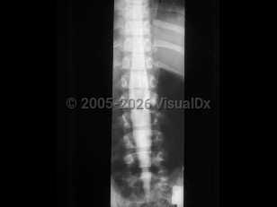 Diastematomyelia