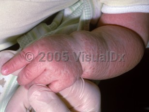 Clinical image of Severe combined immunodeficiency - imageId=2406656. Click to open in gallery.  caption: 'Diffuse pink papules and plaques on the arm of an infant with the X-linked form SCID.'