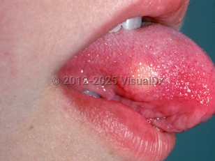 Clinical image of Granular cell tumor - imageId=2449538. Click to open in gallery.  caption: 'A yellowish nodule on the lateral tongue.'