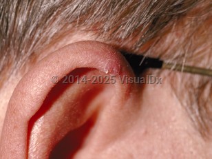Clinical image of Chondrodermatitis nodularis helicis - imageId=24495. Click to open in gallery.  caption: 'A small crusted papule with a collarette of scale on the helix.'