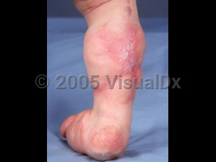 Clinical image of Lipoblastomatosis - imageId=2453048. Click to open in gallery.  caption: 'A diffusely enlarged leg and foot with overlying surgical scars and reddish plaques on the foot.'