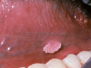 Clinical image of Oral papilloma - imageId=2487516. Click to open in gallery.  caption: 'A pink and whitish verrucous papule on the ventral tongue.'