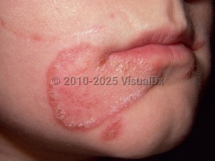 Clinical image of Tinea faciei - imageId=261440. Click to open in gallery.  caption: 'An annular, pink, scaly, and crusted plaque on the chin and a similar nearby papule.'