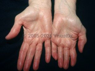 Erythromelalgia
