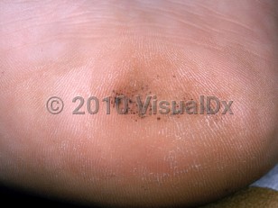 Clinical image of Talon noir - imageId=2724295. Click to open in gallery.  caption: 'A light brown patch with black and gray peppering on the heel.'
