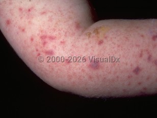 Acute meningococcemia