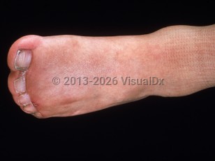 Clinical image of Apert syndrome - imageId=2763659. Click to open in gallery.  caption: 'Marked syndactyly of the toes.'