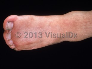 Clinical image of Apert syndrome - imageId=2763659. Click to open in gallery.  caption: 'Marked syndactyly of the toes.'