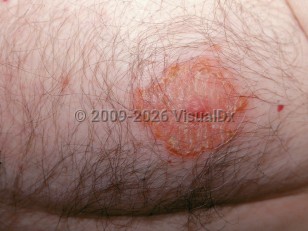 Nipple dermatitis