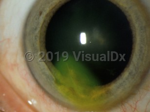 Ophthalmic Imaging image of Ruptured globe - imageId=2841031. Click to open in gallery. 