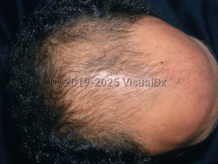 Clinical image of Male pattern alopecia - imageId=2863495. Click to open in gallery.  caption: 'Extensive thinning of hair over the frontal scalp.'