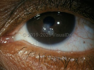 Ophthalmic Imaging image of Distichiasis - imageId=2903865. Click to open in gallery.  caption: 'Tiny hairs arising from meibomian gland openings on the eyelid margin.'
