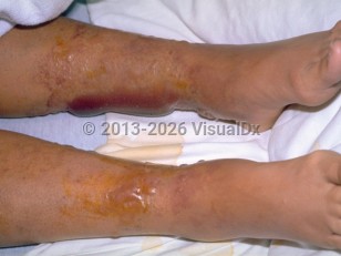 Clinical image of Vibrio vulnificus infection - imageId=291036. Click to open in gallery.  caption: 'Several vesicles and large bullae, some hemorrhagic, with surrounding purpura on the legs.'