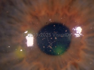 Ophthalmic Imaging image of Corneal abrasion - imageId=2911612. Click to open in gallery. 