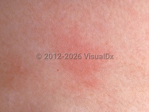 Clinical image of Cholinergic urticaria - imageId=29148. Click to open in gallery.  caption: 'Two urticarial erythematous plaques, each with a central urticarial papule.'