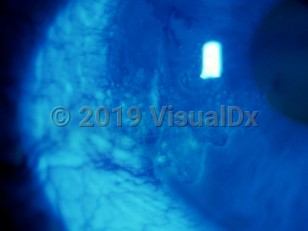 Ophthalmic Imaging image of Corneoconjunctival intraepithelial neoplasia - imageId=2915964. Click to open in gallery. 