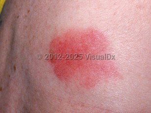 Clinical image of Bumblebee sting - imageId=2936113. Click to open in gallery.  caption: 'A close-up of an urticarial plaque with a central punctum.'