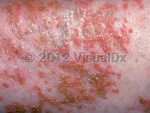 Clinical image of Glucagonoma syndrome - imageId=2949314. Click to open in gallery.  caption: 'A close-up of many crusted papules.'