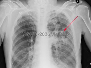 Pulmonary nocardiosis