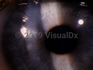 Ophthalmic Imaging image of Lyme keratitis - imageId=2986751. Click to open in gallery. 